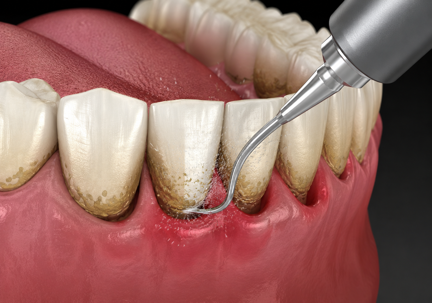 Periodontal Treatment